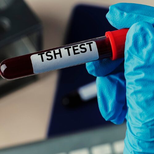 TSH Blood Test